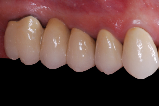 What material is the best choice for a short span fixed partial denture ...